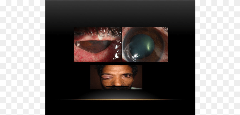 Right Eye Slit Photograph Shows Multiple Injection Cornea, Adult, Male, Man, Person Transparent PNG