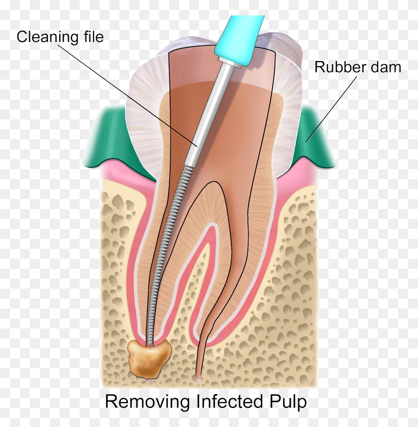 773x798 Root Canal Transparent Artificial Nerves Root Canal, Clothing, Apparel, Footwear HD PNG Download