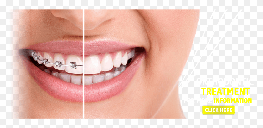 4615x2075 Sevgi Dental Clinic Dental Dental Clinic Dentist Braces Right Before Getting Them Off HD PNG Download