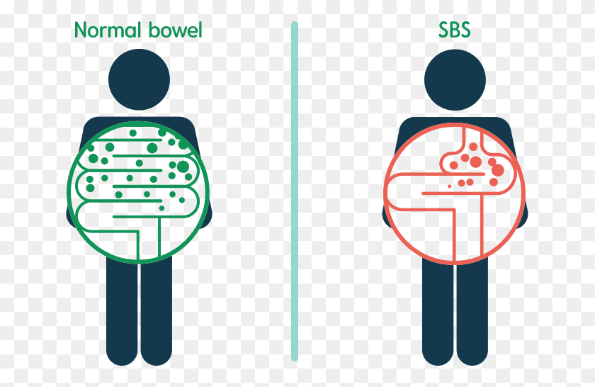653x486 Short Bowel Syndrome Short Bowel Syndrome Patient, Text, Light, Brass Section HD PNG Download