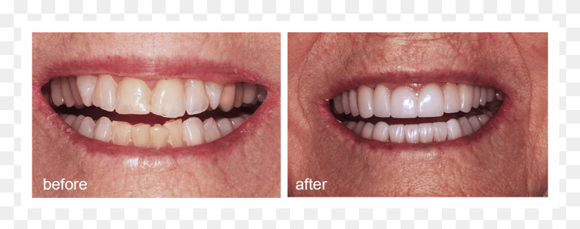 1431x501 Shot Of Before And After Visiting Abington Smile Gallery Aggression, Teeth, Mouth, Lip HD PNG Download