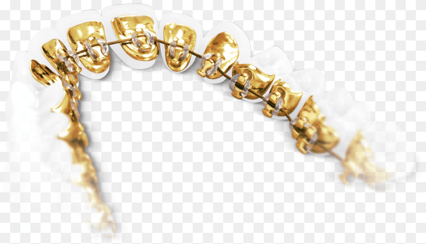 941x540 Show Your Teeth But Not Your Braces The Lingual Technique Incognito Bracket, Body Part, Mouth, Person, Accessories Transparent PNG