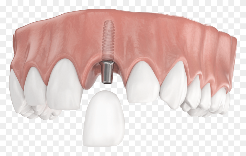 3065x1862 Single Tooth Restoration Tongue HD PNG Download