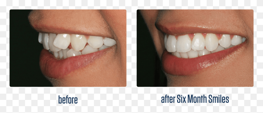 2647x1026 Six Month Smile, Teeth, Mouth, Lip HD PNG Download