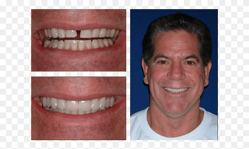 631x444 Smile Gallery Throat, Teeth, Mouth, Lip HD PNG Download