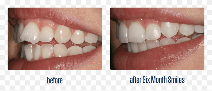 2647x1026 Smile Teeth Before And After Six Month Smile, Mouth, Lip, Egg HD PNG Download