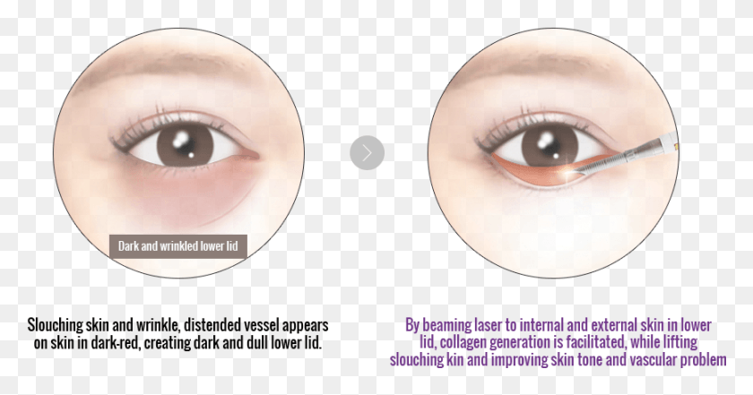 866x424 Some People May Notice Dark Under Eye Circles Moving Eyelash Extensions, Head, Contact Lens, Doll HD PNG Download