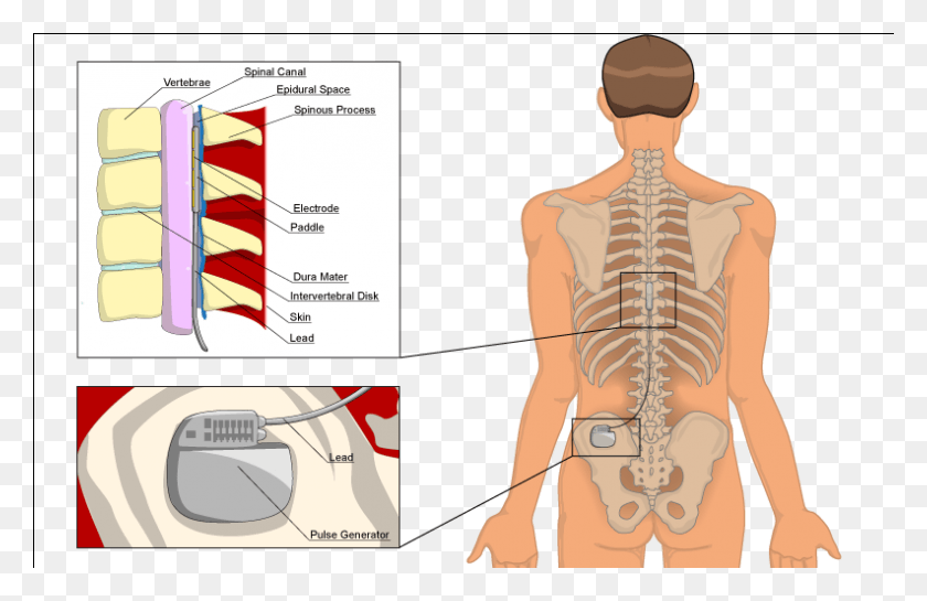 793x494 Spinal Cord Stimulation Uses Low Voltage Stimulation Ibs Spinal Cord Injury, Person, Human, Text HD PNG Download