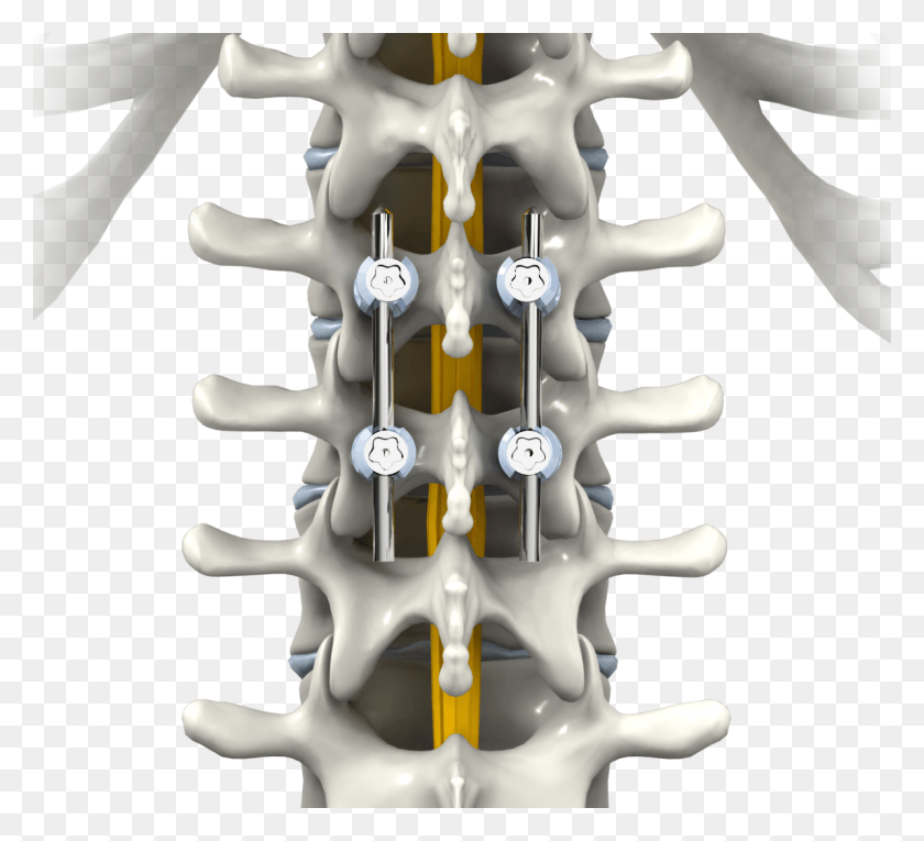 1194x1080 Spinal Fusion Rib, Leisure Activities, Musical Instrument, Toy HD PNG Download