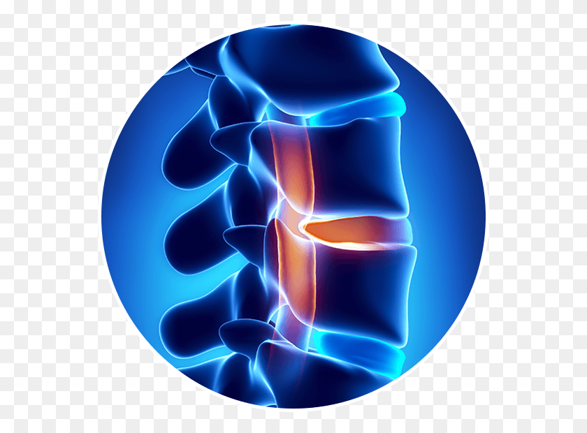 560x560 Spinal Stenosis As We Age Our Spine Degenerates And Spinal Disc Herniation, Graphics, Pattern Descargar Hd Png