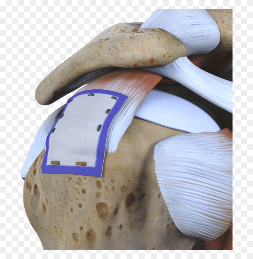 705x801 Study Points To Rotator Cuff Healing And No Tear Progression Biological Patch Rotator Cuff, Plant, Food, Mushroom HD PNG Download