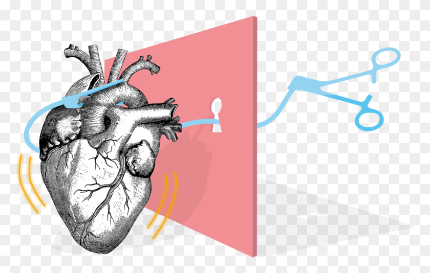 1151x700 Surgery Drawing Open Heart Minimally Invasive Cardiac Surgery Logo, Statue HD PNG Download
