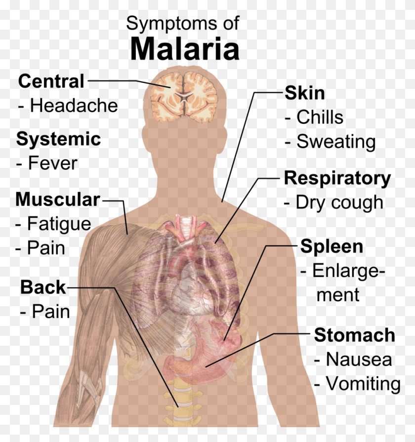 1006x1077 Symptoms Of Malaria Malaria Symptoms, Person, Human, Neck HD PNG Download