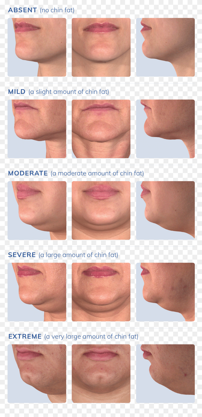 1151x2472 Take A Look At The Photos Below And Select The Image Double Chin Stages, Jaw, Collage, Poster HD PNG Download