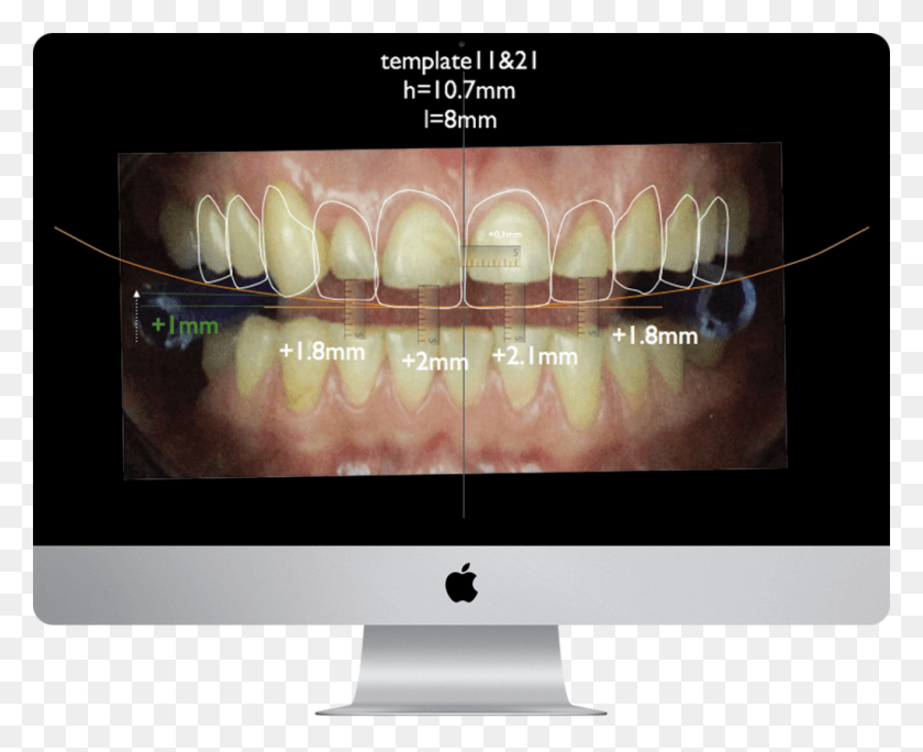 1024x820 Teaser Digital Smile Design Computer Monitor, Teeth, Mouth, Lip HD PNG Download