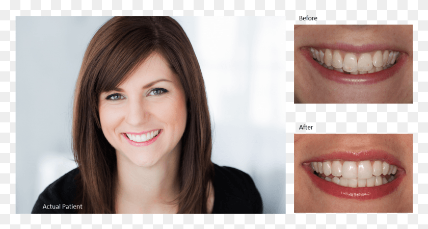 1189x593 Teeth Straightening With Invisalign Girl, Face, Person, Human HD PNG Download