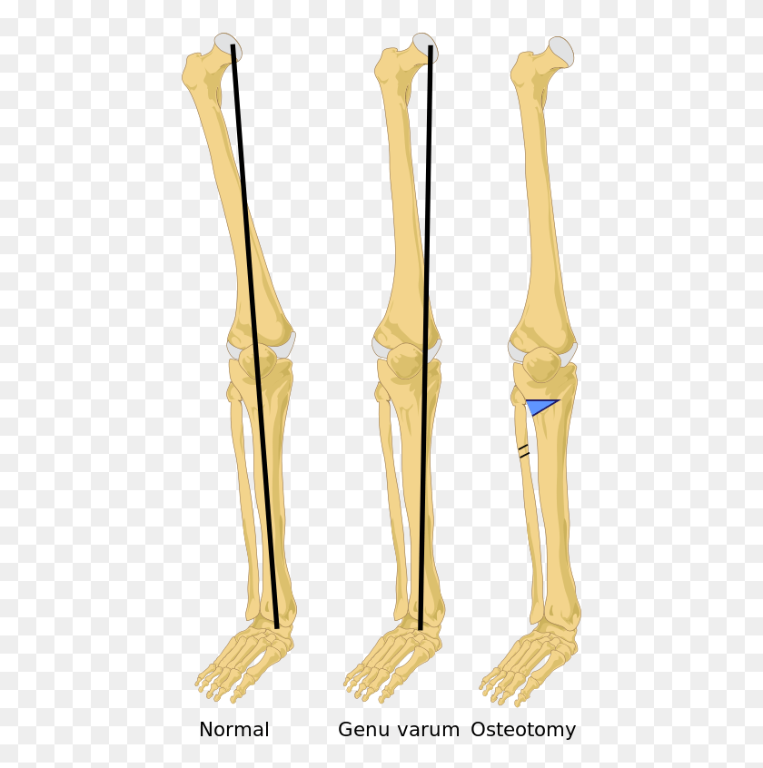 440x786 The Black Line Is The Mechanical Axis Tibia Varus, Skeleton, Tie, Accessories HD PNG Download