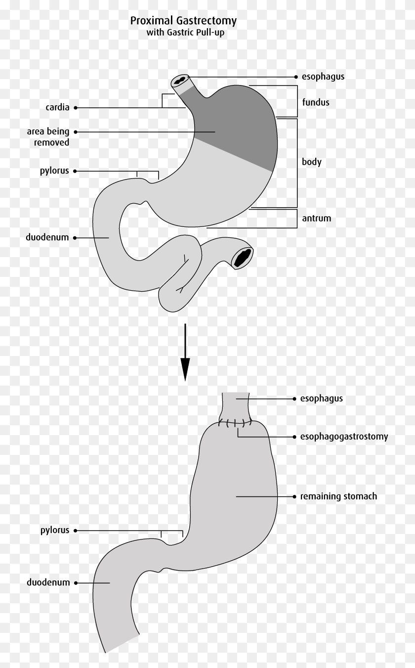 735x1291 The Gastrointestinal Tract Is Then Reconstructed By Proximal Gastrectomy, Architecture, Building, Cylinder HD PNG Download