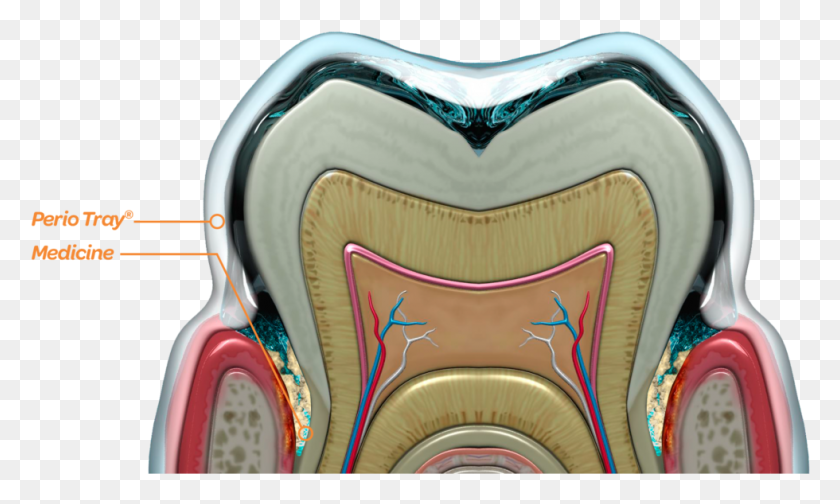 980x558 The Perio Tray Delivers Medicine Into The Periodontal Hearing, Building, Architecture, Cushion HD PNG Download