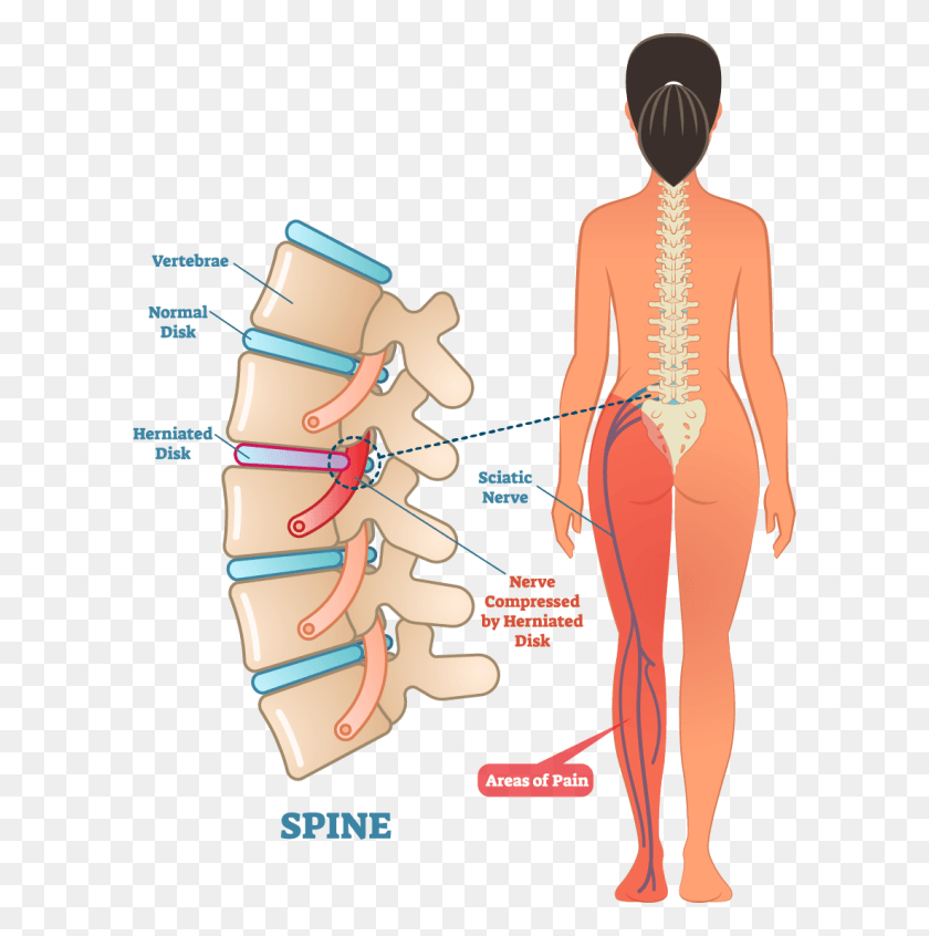 600x786 La Columna Espinal Está Formada Por 33 Huesos Llamados Vértebra Nervio Ciático Ubicación, Persona, Humano, Trama Hd Png