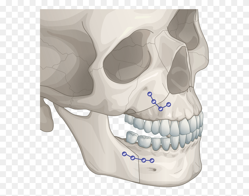 571x604 Two Jaw Surgery Orthognathic Surgery, Teeth, Mouth, Lip HD PNG Download