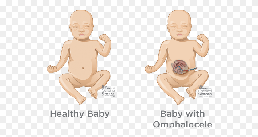 538x387 Typically During Week 6 To 10 Of Pregnancy A Baby39s Bronchopulmonary Sequestration Bps, Person, Human, Baby HD PNG Download