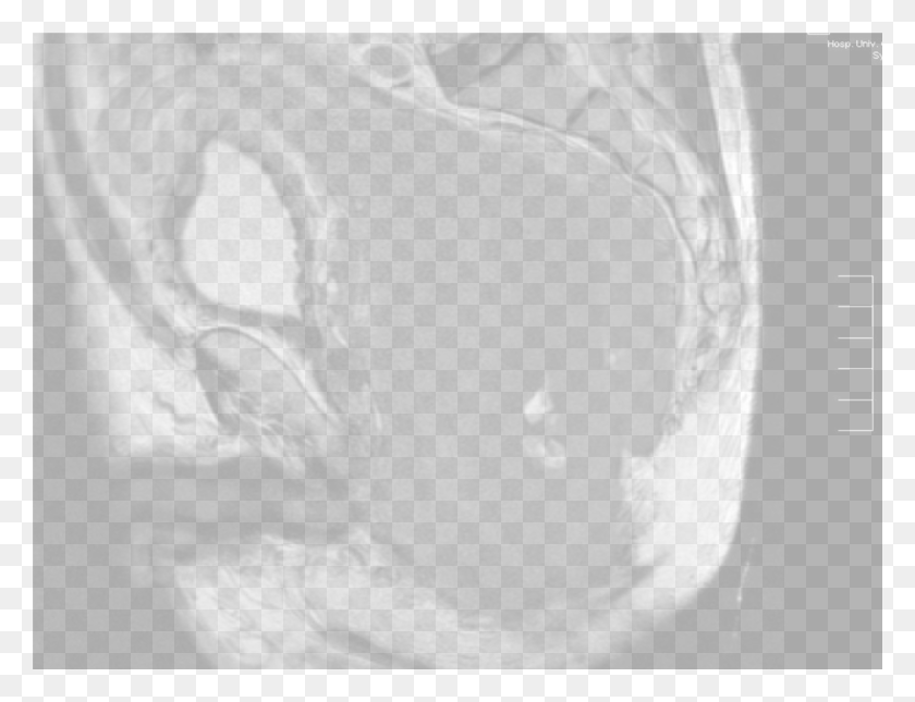 1365x1024 Uncommon Tumor And Tumor Like Lesions Of The Rectum Computed Tomography, X-ray, Ct Scan, Medical Imaging X-ray Film HD PNG Download