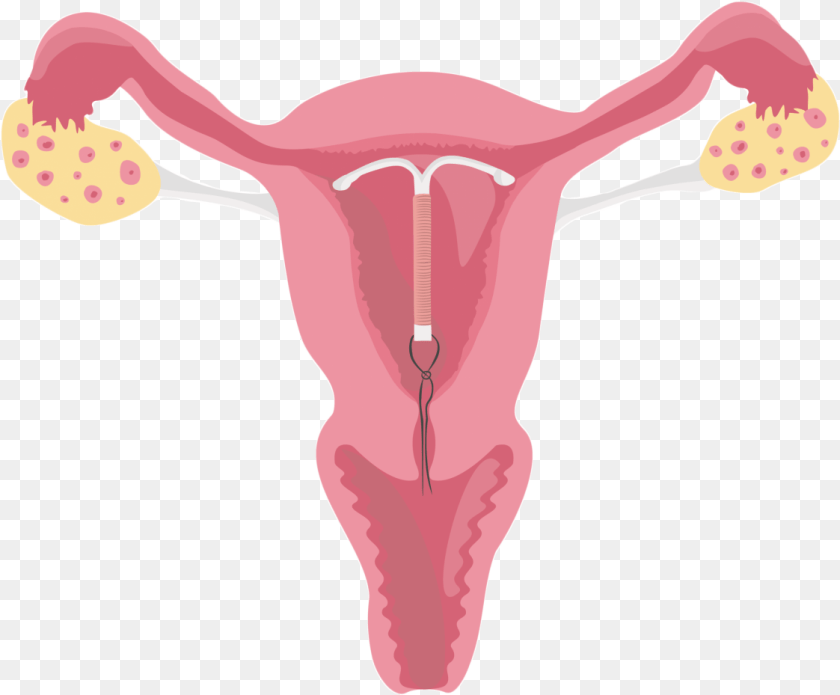 Uterus Female Reproductive System With Iud, Baby, Person, Body Part, Mouth Sticker PNG
