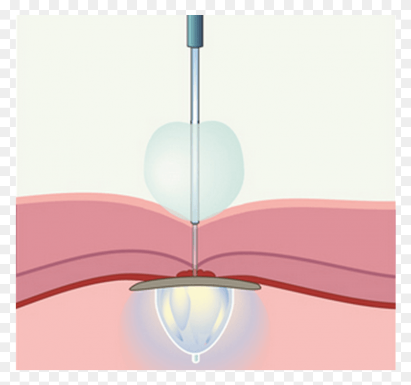 805x751 Uv Light And Balloons Can Plug Holes In Your Heart Heart, Lamp, Light Fixture HD PNG Download