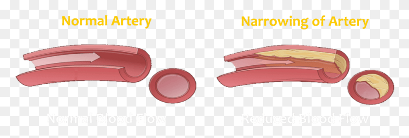 940x272 Vascular What Is Vascular Disease 12 Narrowing Of Blood Vessel, Clothing, Apparel, Leisure Activities HD PNG Download
