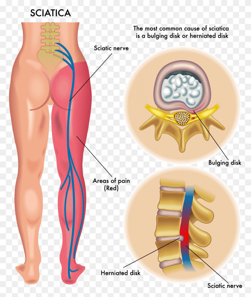 856x1024 What Causes Sciatic Nerve Sciatica Pain, Plot, Diagram, Female HD PNG Download