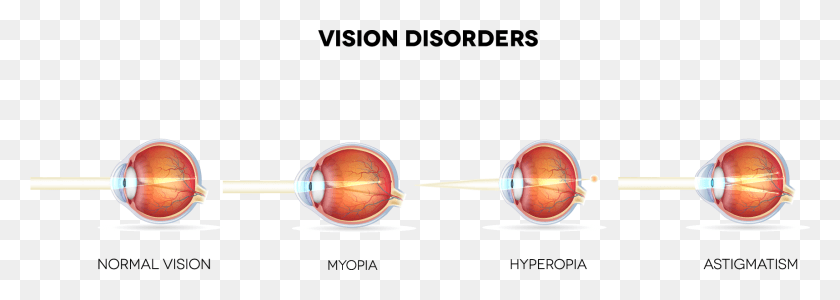 1715x529 What Eye Conditions Does Lasik Treat Normal Eye Vs Myopia, Sphere, Astronomy, Outer Space HD PNG Download