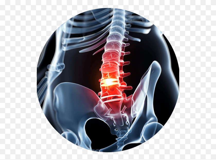 555x562 When The Spine Begins To Narrow Putting Pressure On Dubla Hernie De Disc, X-ray, Medical Imaging X-ray Film, Ct Scan HD PNG Download