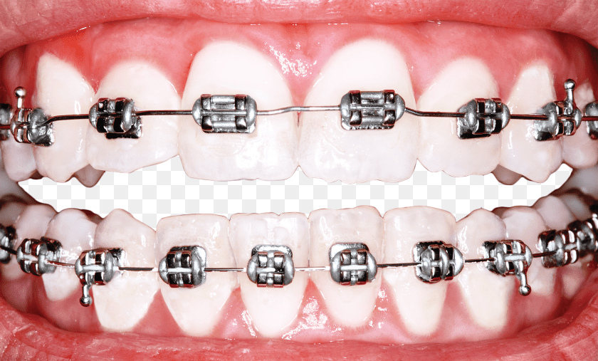 2048x1236 Why Is America Obsessed With Perfect Teeth Science Braces For Teeth Transparent PNG