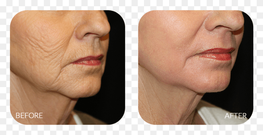 842x404 Wrinkles Creases And Sags Are Inevitable As We Age Deep Chemical Peel, Face, Person, Human HD PNG Download