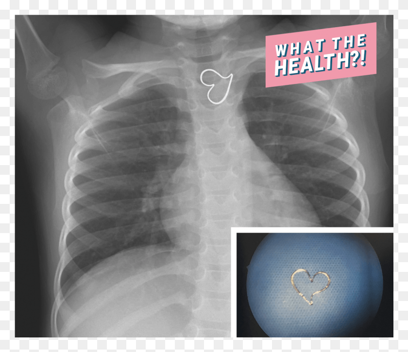 1201x1024 X Ray Heart Medical Doctor Hospital Found Woman Health X Ray, X-ray, Medical Imaging X-ray Film, Ct Scan HD PNG Download