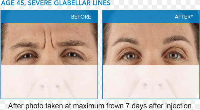 971x536 Xeomin Results 45u Dysport In Glabella, Art, Sad, Collage, Face Clipart PNG